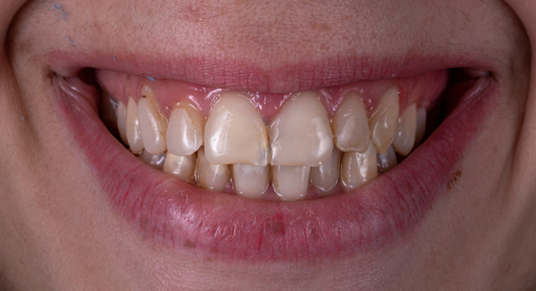 Common Questions About Implant Supported Dentures